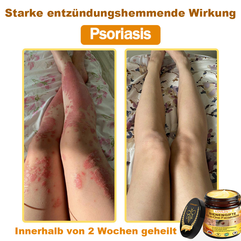 [offizieller Markenshop] 🐝 LOVILDS™ Bienengift-All-Action-Creme (👩‍⚕️ Deutsche Dermatologische Gesellschaft e.V. 𝟐𝟎𝟐𝟓Besonders empfehlenswerte Produkte)